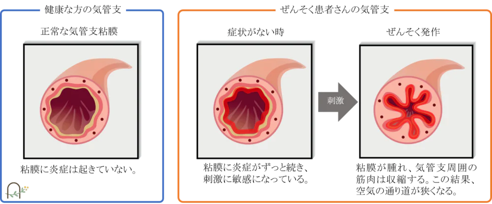 気管支ぜんそくってどんな病気？