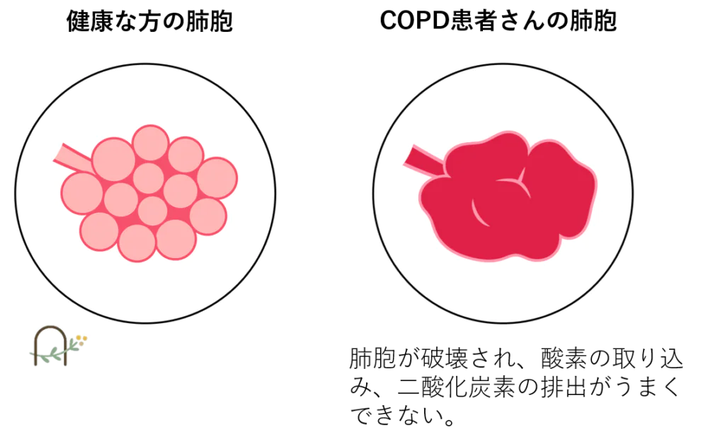 どうしてCOPDになってしまうの？