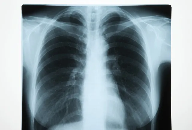 肺のレントゲン