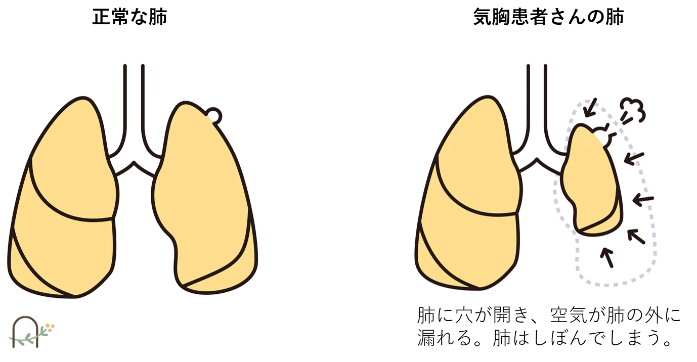 気胸ってどんな病気？