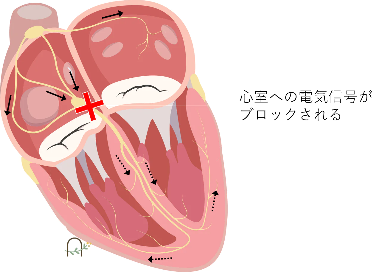 房室ブロック