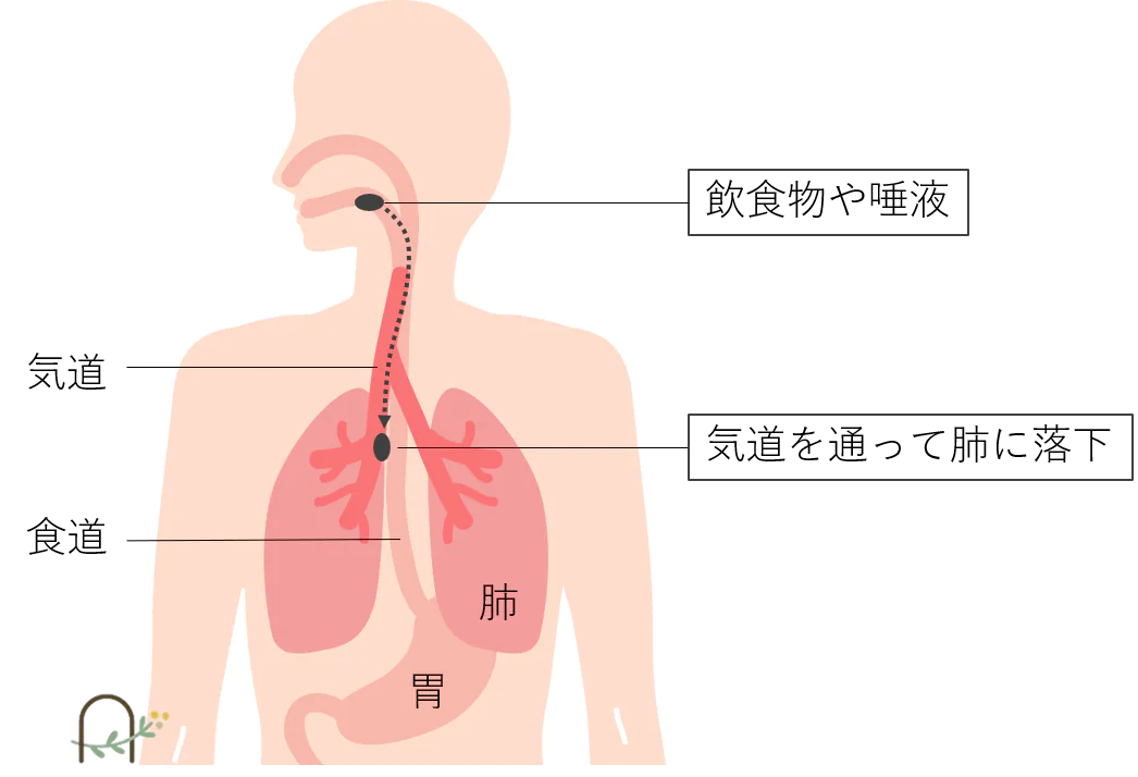 誤嚥性肺炎