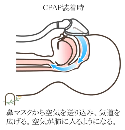 経鼻的持続陽圧呼吸療法（CPAP）