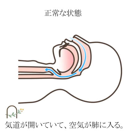 どうして睡眠時無呼吸症候群になってしまうの？